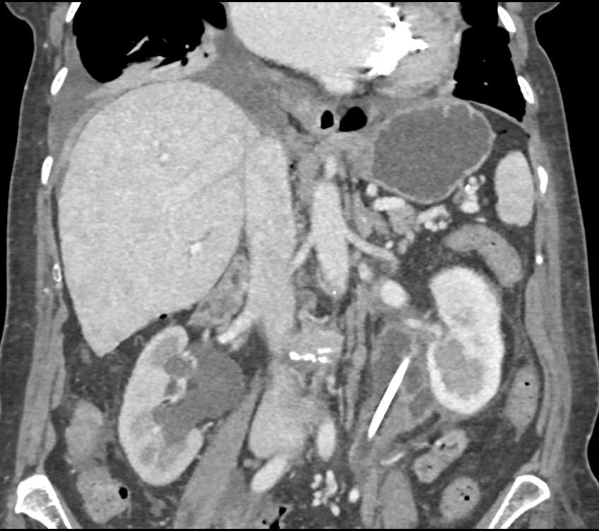 Transitional Cell Cancer (TCC) Involving Left Renal Pelvis and Ureter - CTisus CT Scan
