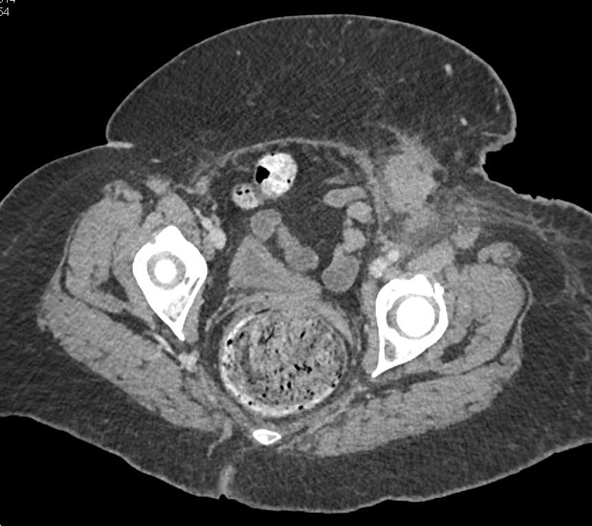 Multiple Right Renal Infarcts - CTisus CT Scan