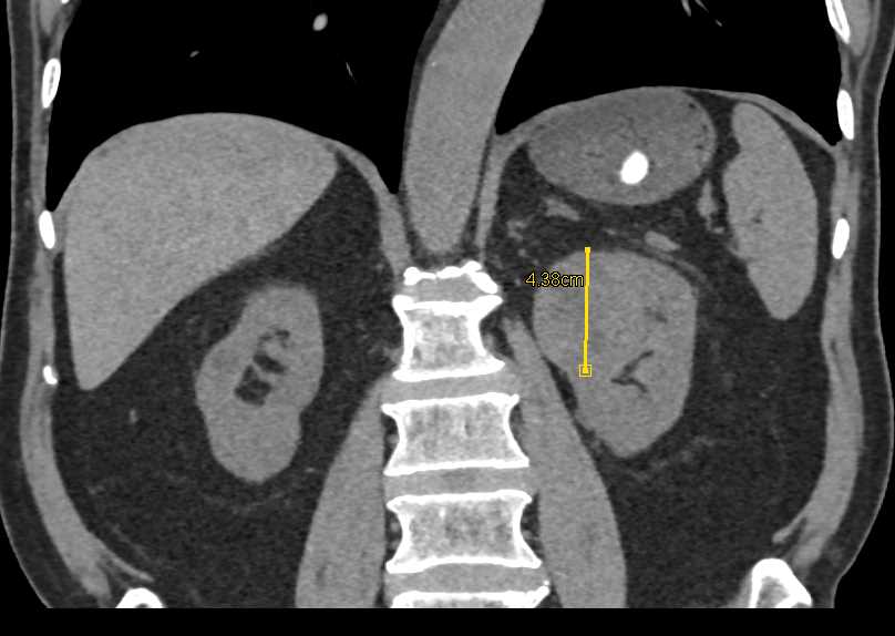 Clear Cell Left Renal Cell Carcinoma - CTisus CT Scan