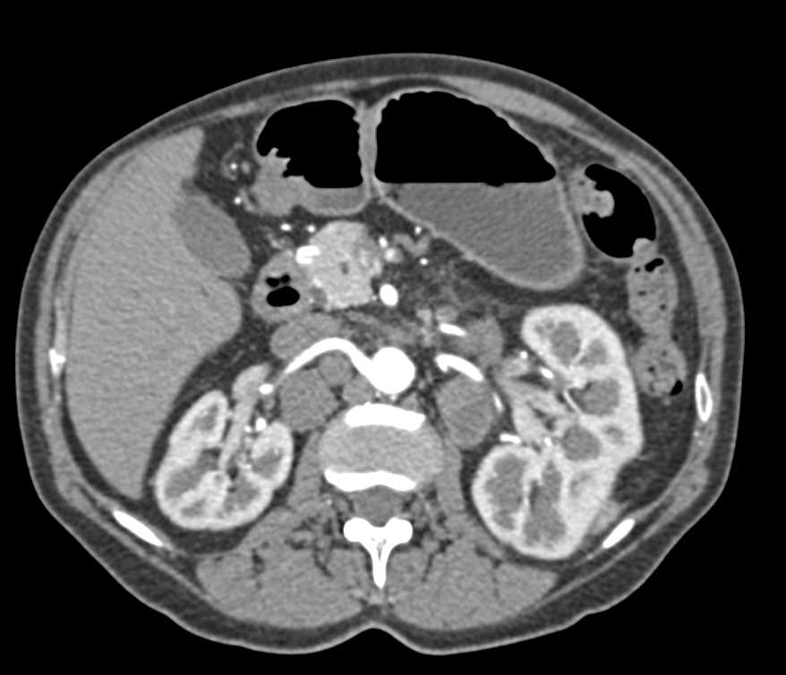 Cystic Renal Cell Carcinoma with Para-Aortic Adenopathy - CTisus CT Scan