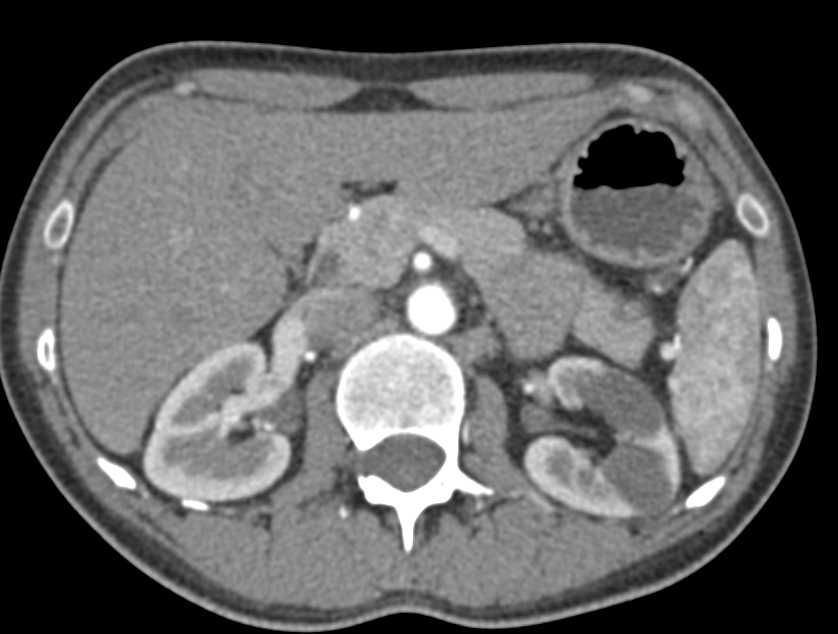 Dilated Calyces in the Lower Pole of the Left Kidney - CTisus CT Scan
