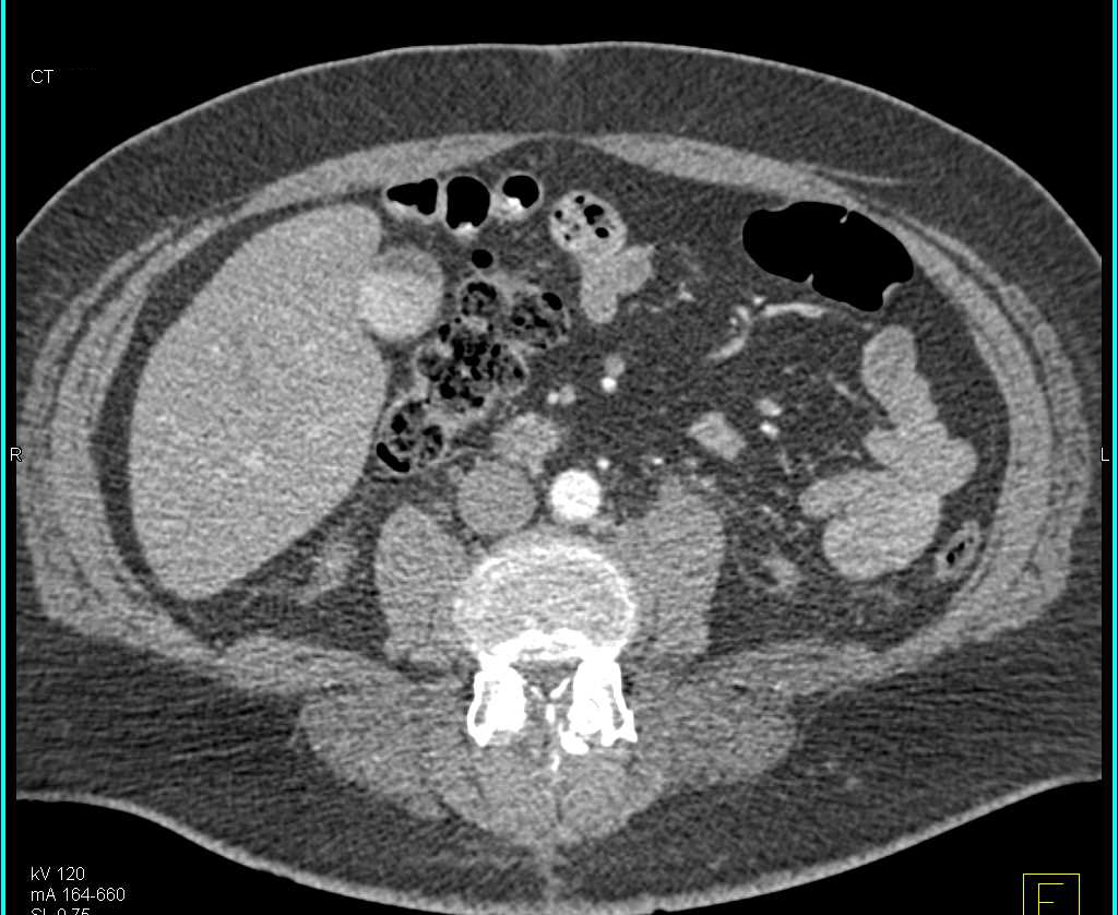 Incidental Left Bladder Wall Cancer - CTisus CT Scan