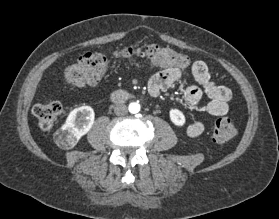 Angiomyolipoma (AML) Lower Pole Right Kidney - CTisus CT Scan