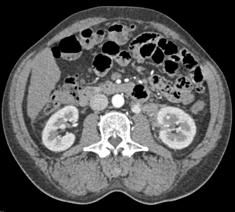 Transitional Cell Carcinoma Left Kidney - CTisus CT Scan