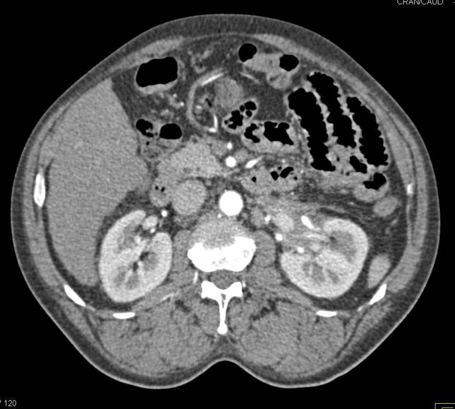 Transitional Cell Carcinoma Left Kidney - CTisus CT Scan