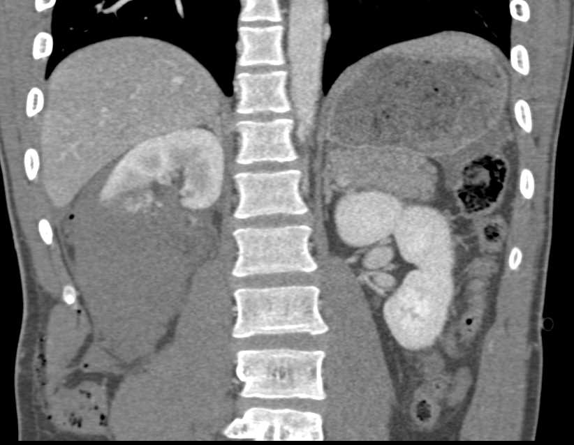 GSW with Renal and Duodenal Injury with Active Bleed Defined - CTisus CT Scan
