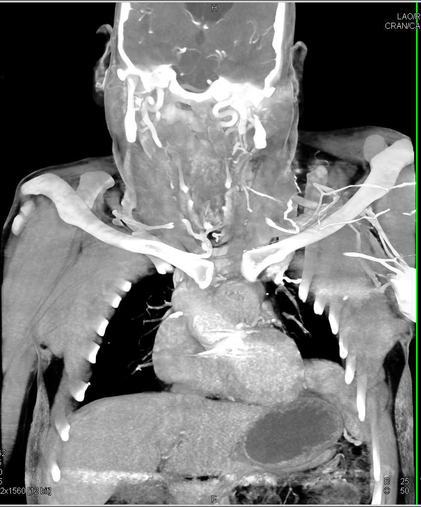 Renal Cell Carcinoma and Carcinomatosis - CTisus CT Scan