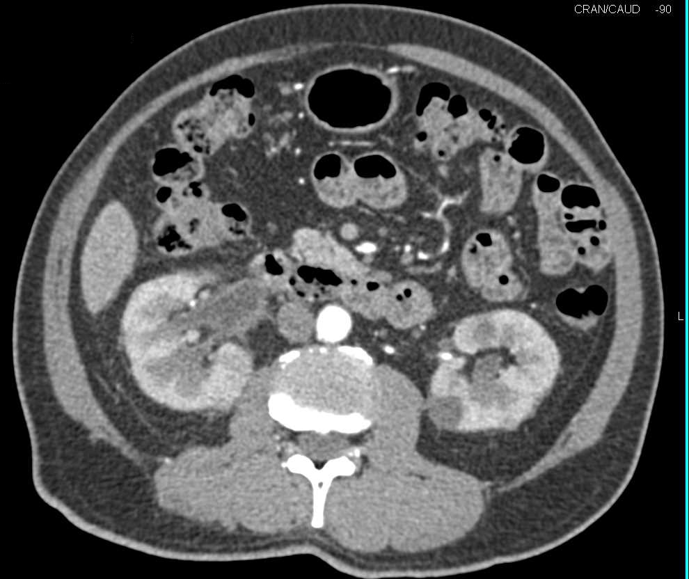 Transitional Cell Carcinoma of the Right Renal Pelvis, Ureter and Bladder - CTisus CT Scan