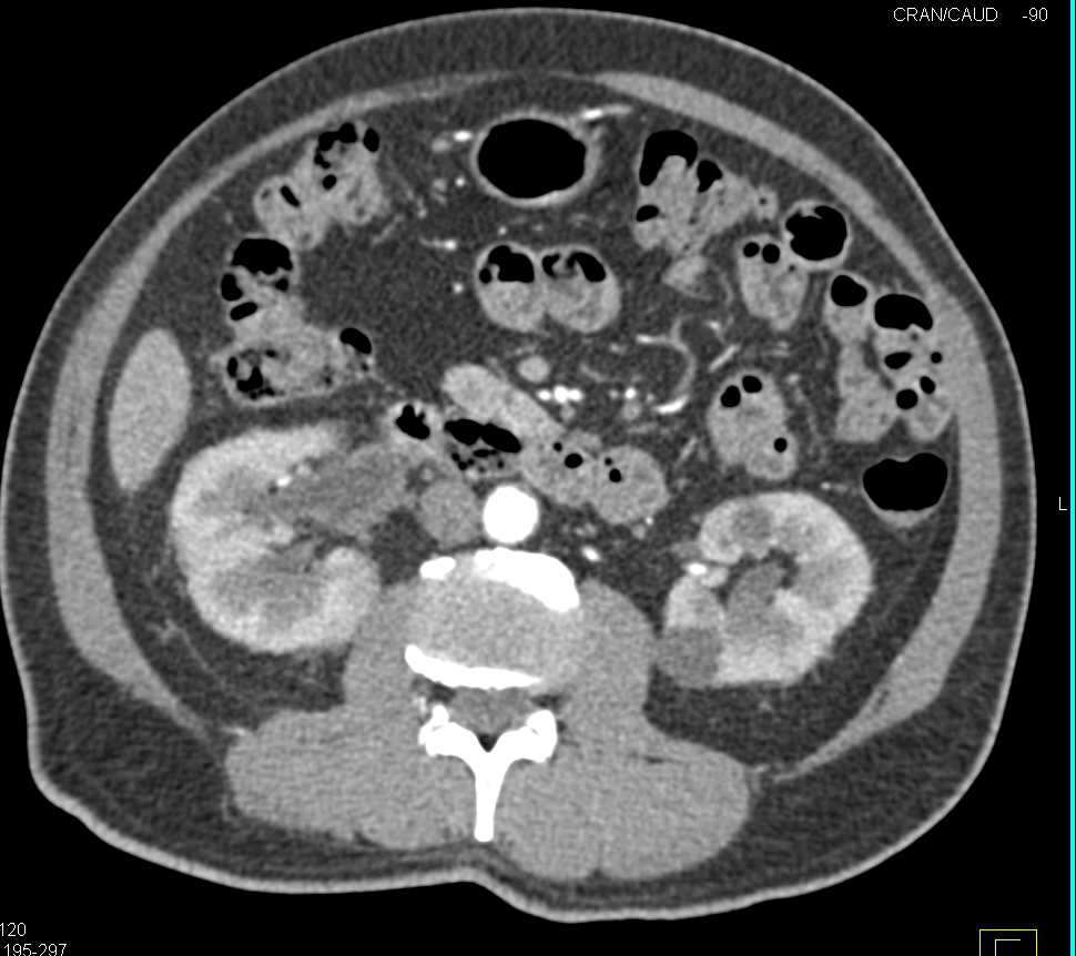 Transitional Cell Carcinoma of the Right Renal Pelvis, Ureter and Bladder - CTisus CT Scan