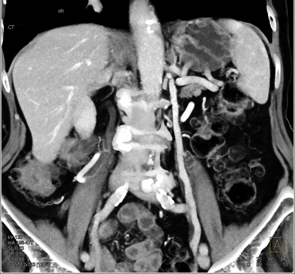 Subtle Transitional Cell Carcinoma Left Renal Pelvis - CTisus CT Scan