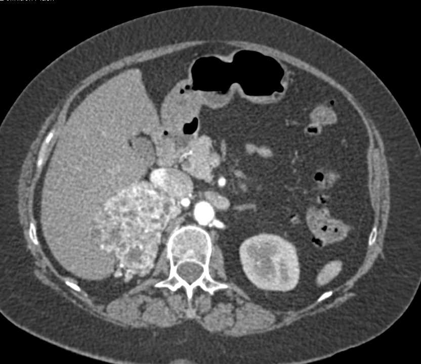 Vascular Renal Cell Carcinoma was a Clear Cell Renal Cell Carcinoma - CTisus CT Scan