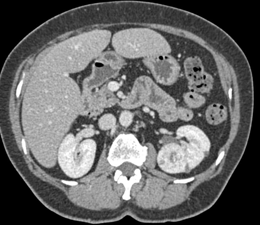 Incidental Left Renal Cell Carcinoma in a Patient Presenting with Left Hip Pain - CTisus CT Scan