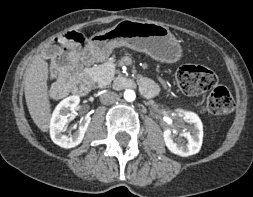 Stone in Inflamed Left Renal Pelvis - CTisus CT Scan