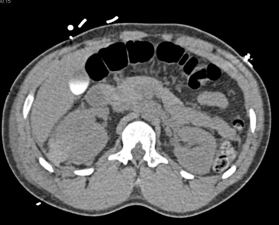 Active Bleed Right Kidney with Renal Laceration and Pelvic Bleed - CTisus CT Scan