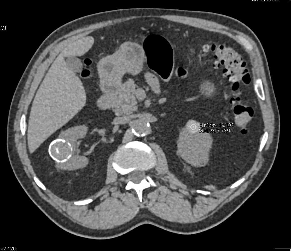 Bosniak 2F Cysts - CTisus CT Scan