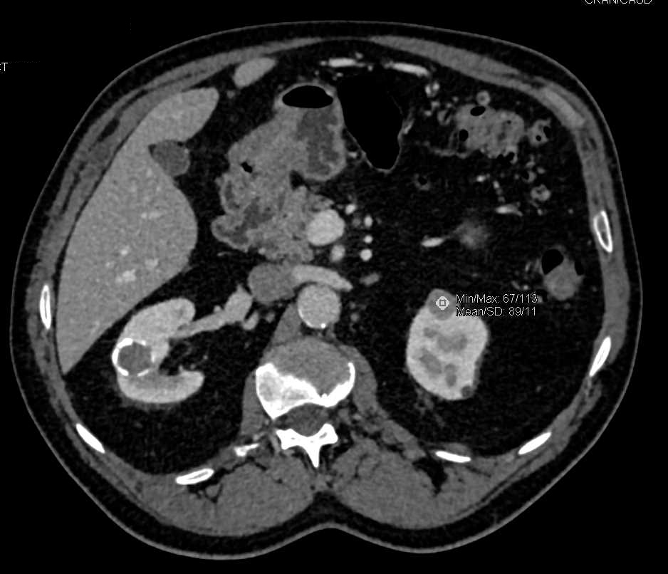 High Density Cyst Left Kidney - CTisus CT Scan