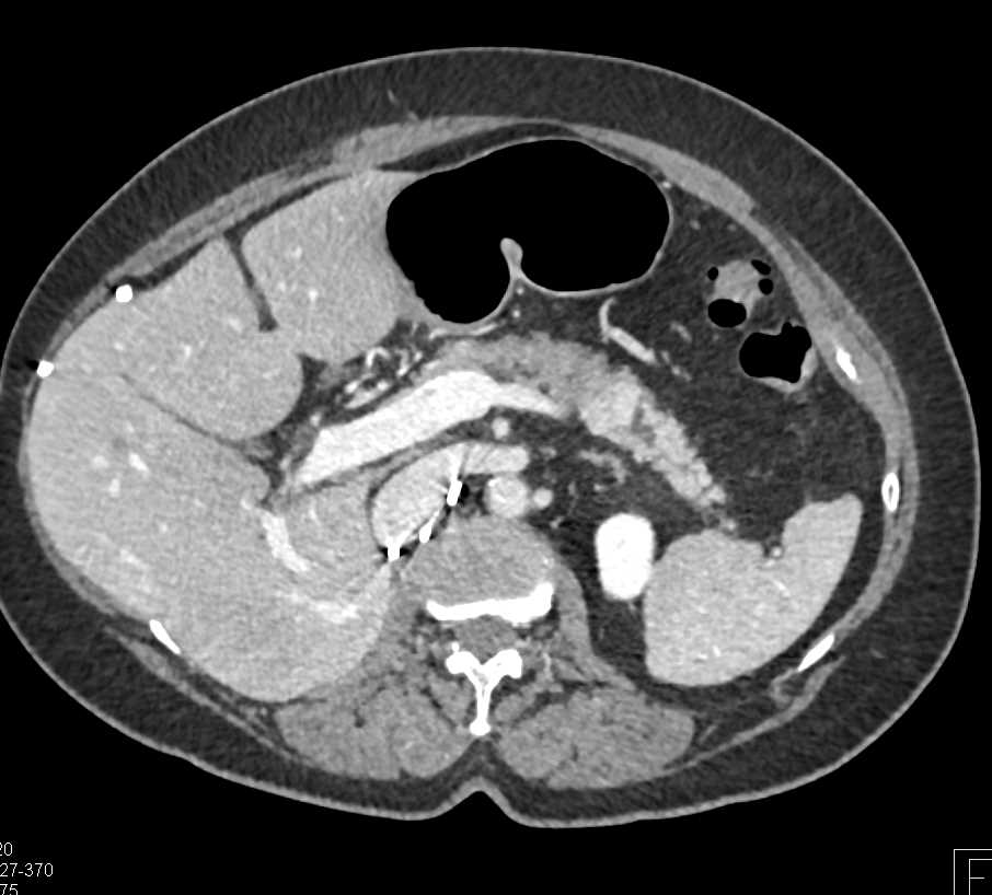 Metastatic Renal Cell Carcinoma to the Pancreas - CTisus CT Scan