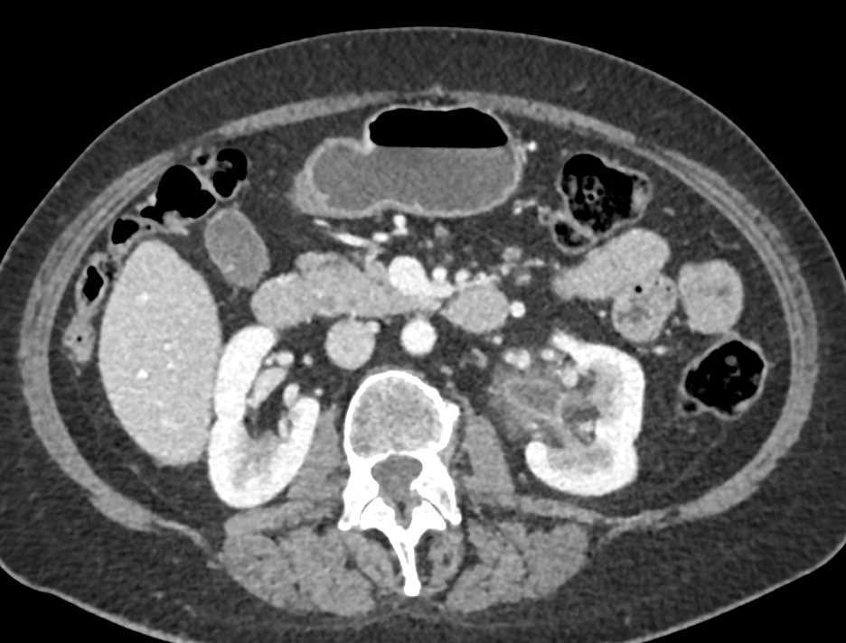Transitional Carcinoma Left Kidney - CTisus CT Scan