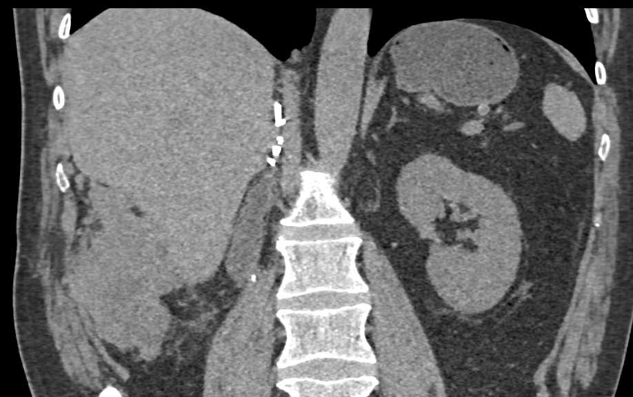 Recurrent Clear Cell Renal Cell Carcinoma (RCC) to Zone Near Inferior Border of the Liver - CTisus CT Scan