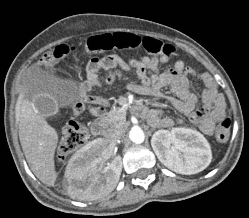 Acute Pyelonephritis Right Kidney - CTisus CT Scan