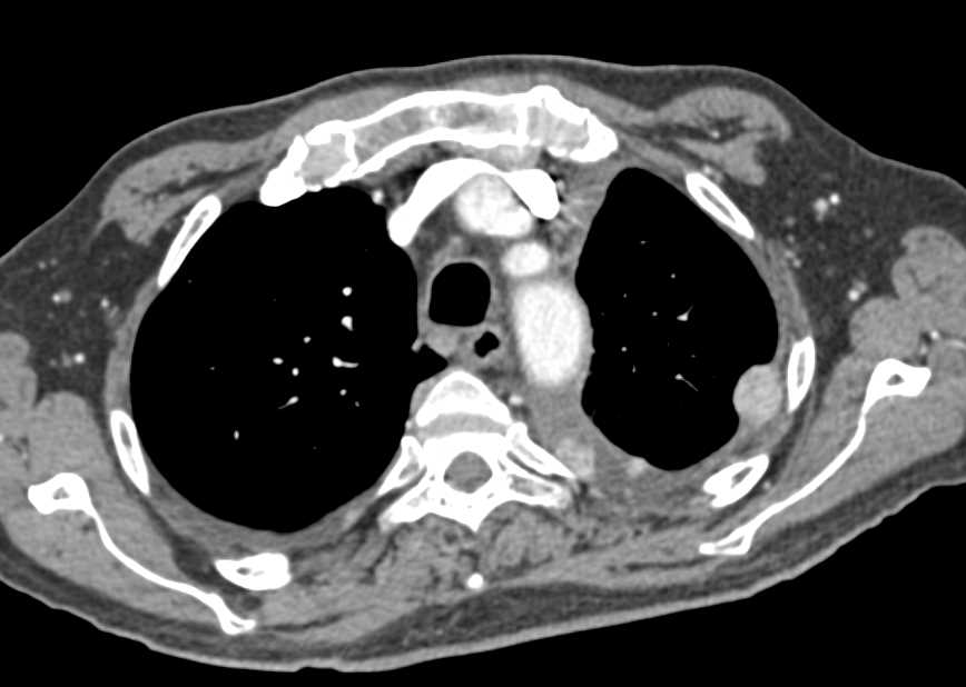 Recurrent Renal Cell Carcinoma with Extensive Metastases Especially to the Chest - CTisus CT Scan