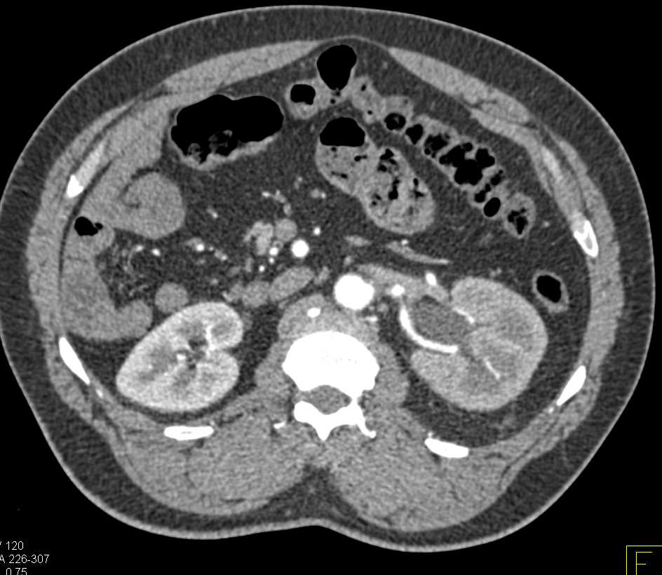 Obstructing Stone in the Distal Left Ureter - CTisus CT Scan