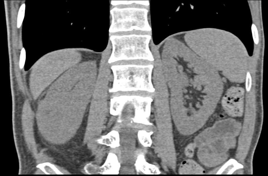 Small Angiomyolipoma (AML) of the Right Kidney - CTisus CT Scan