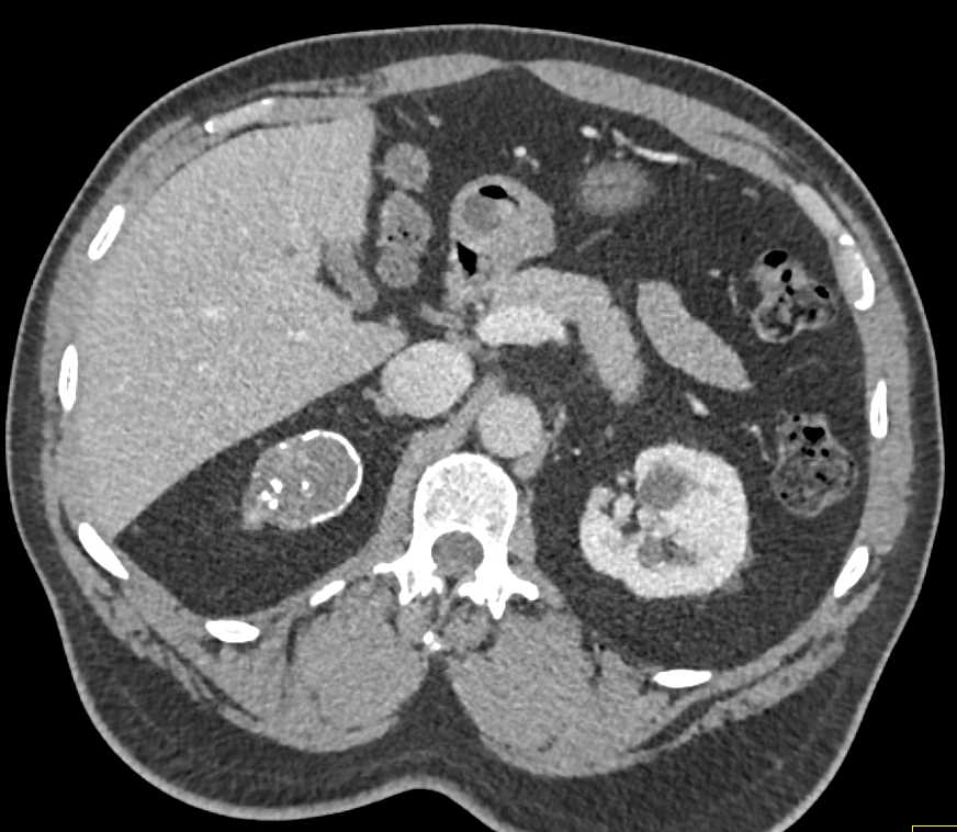 Partially Calcified Renal Cell Carcinoma - CTisus CT Scan