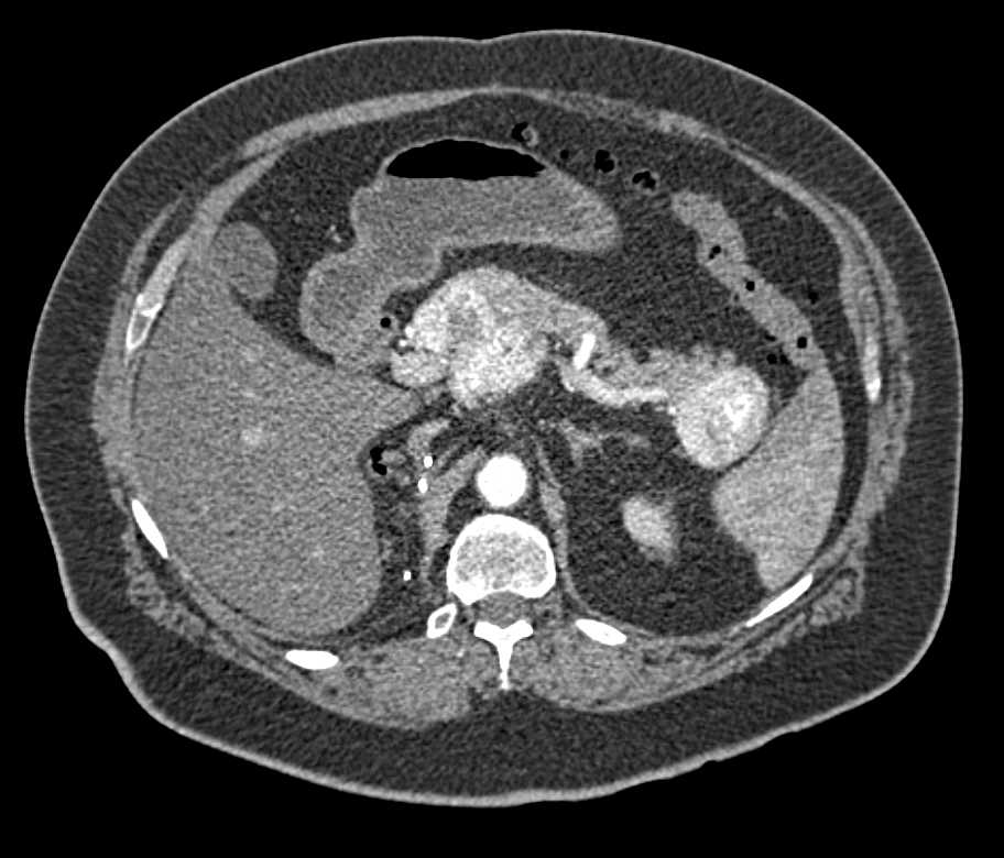 Recurrent Renal Cell Carcinoma with Metastases to the Pancreas - CTisus CT Scan