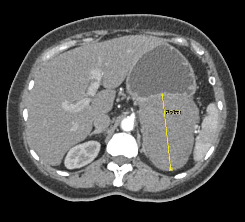 Gastric GIST Tumor - CTisus CT Scan