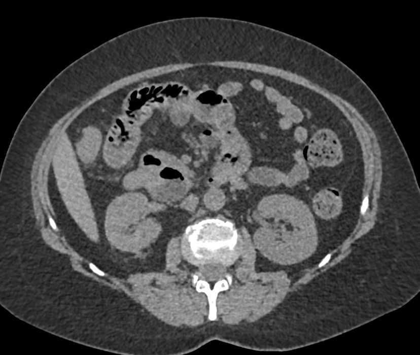 Papillary Necrosis Best Seen on 3D Images - CTisus CT Scan