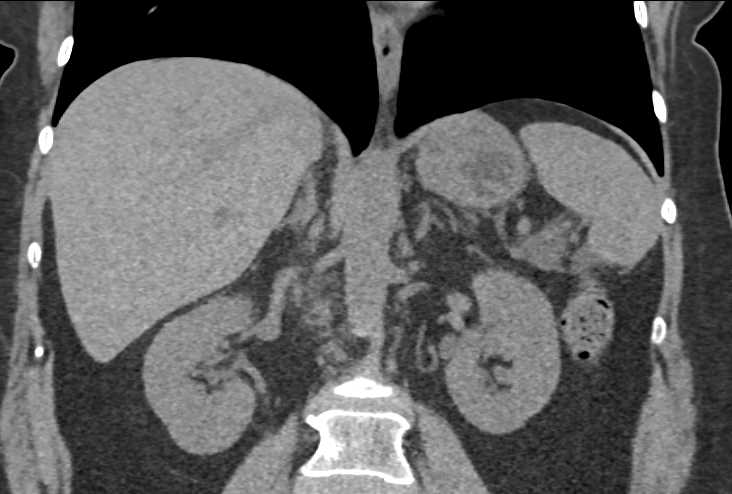 Papillary Necrosis Best Seen on 3D Images - CTisus CT Scan