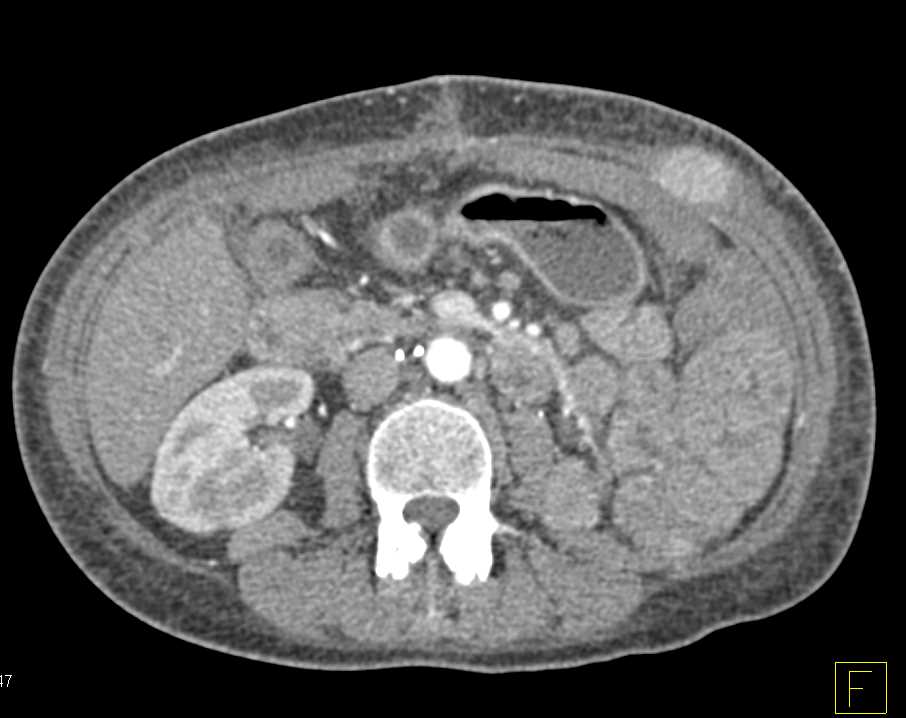 Metastatic Renal Cell Carcinoma to Muscle, Bone and Small Bowel - CTisus CT Scan