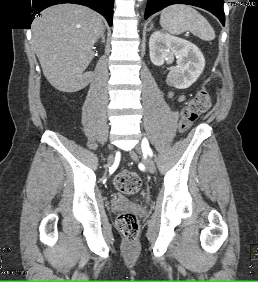 Post RF Changes in the Left Kidney - CTisus CT Scan