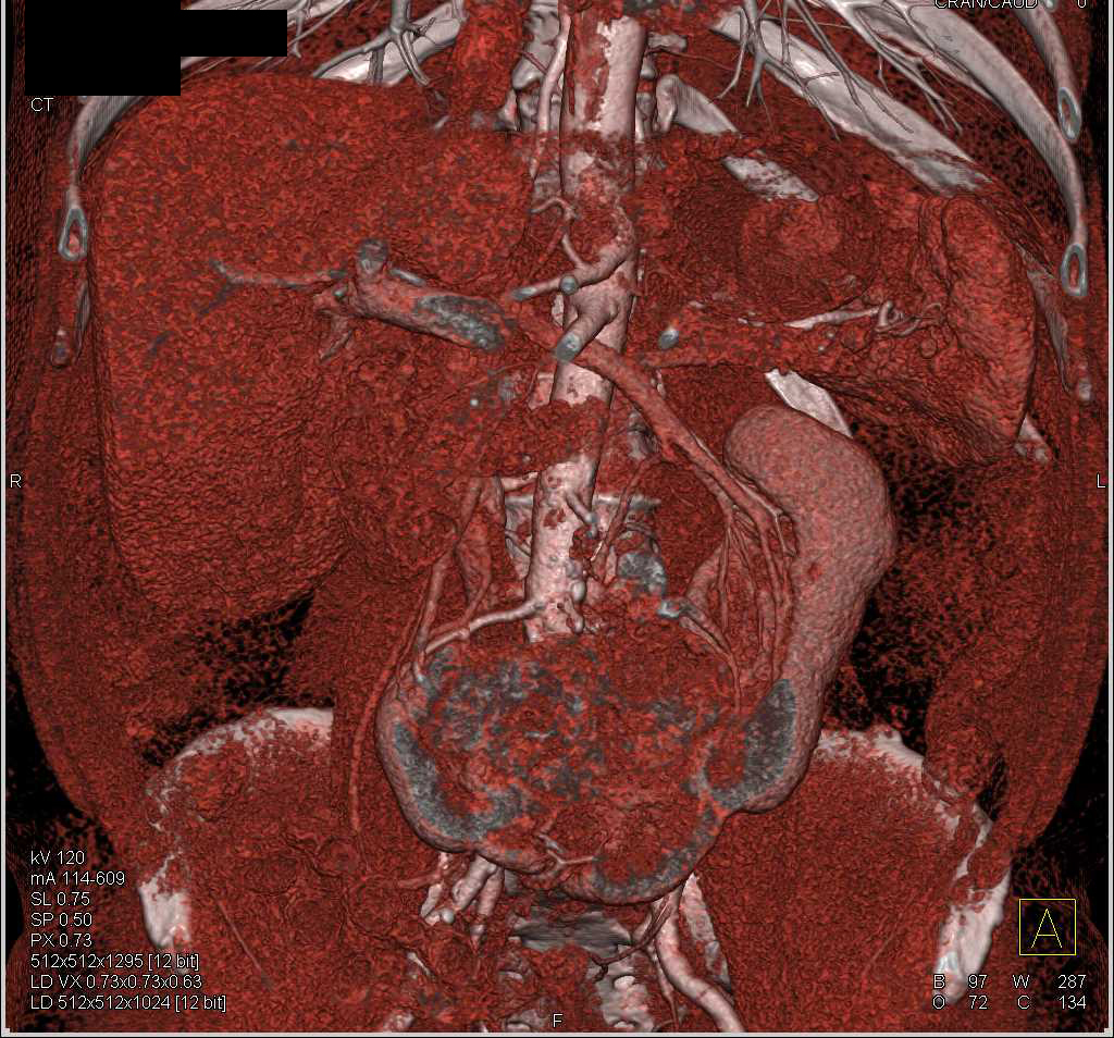 Renal Cell Carcinoma in a Horseshoe Kidney with CTA Mapping - CTisus CT Scan