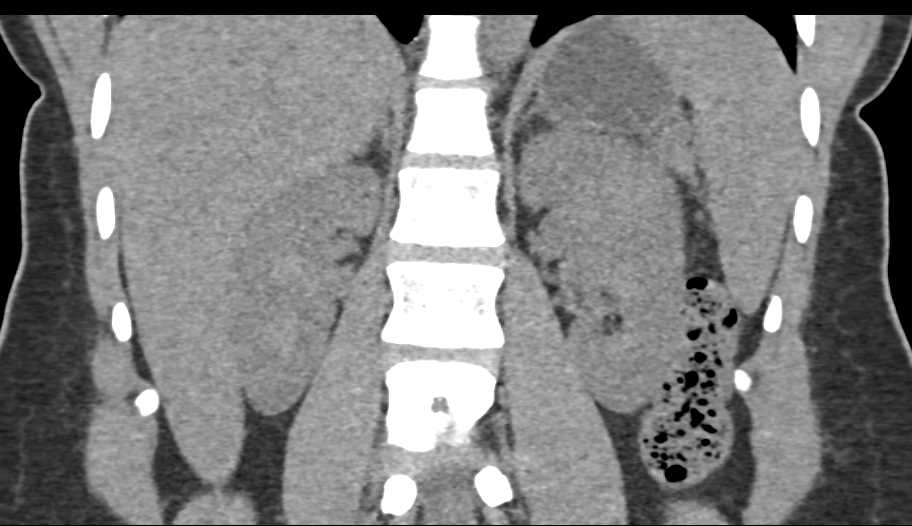 Oncocytoma Left Kidney - CTisus CT Scan