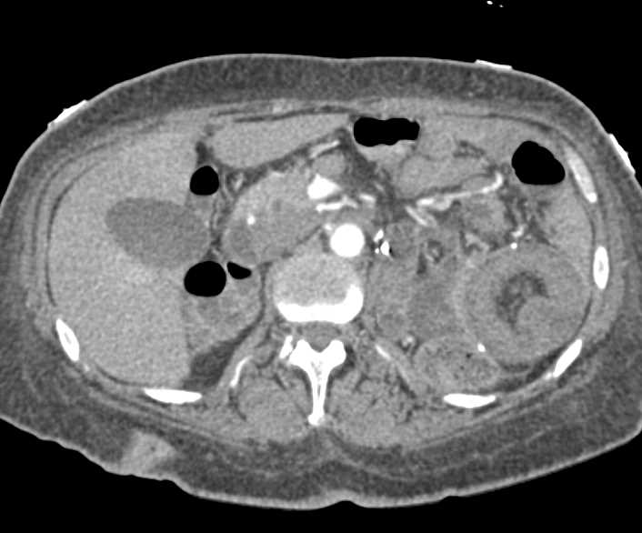 Multiple Small Bowel Intussusceptions Without Tumor in End Stage Renal Disease (ESRD) Patient - CTisus CT Scan