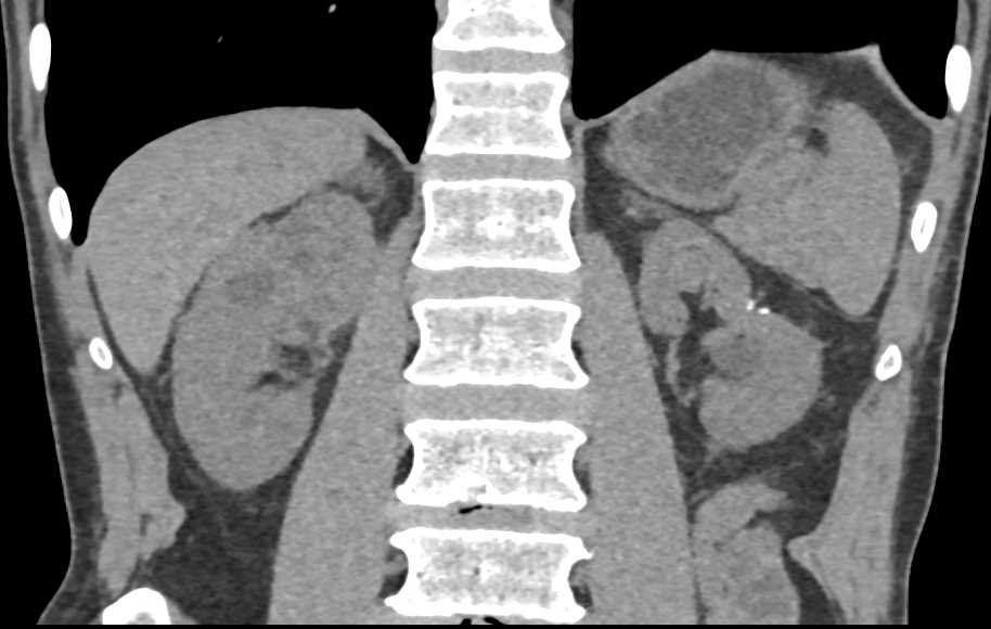 Transitional Cell Carcinoma Upper Pole of the Right Kidney - CTisus CT Scan