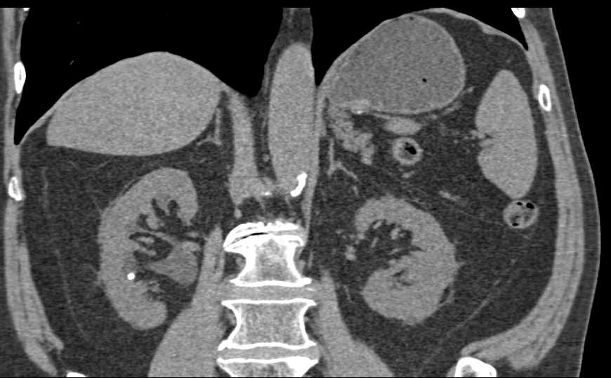 Ureteropelvic Junction (UPJ) Obstruction of the Right Kidney - CTisus CT Scan