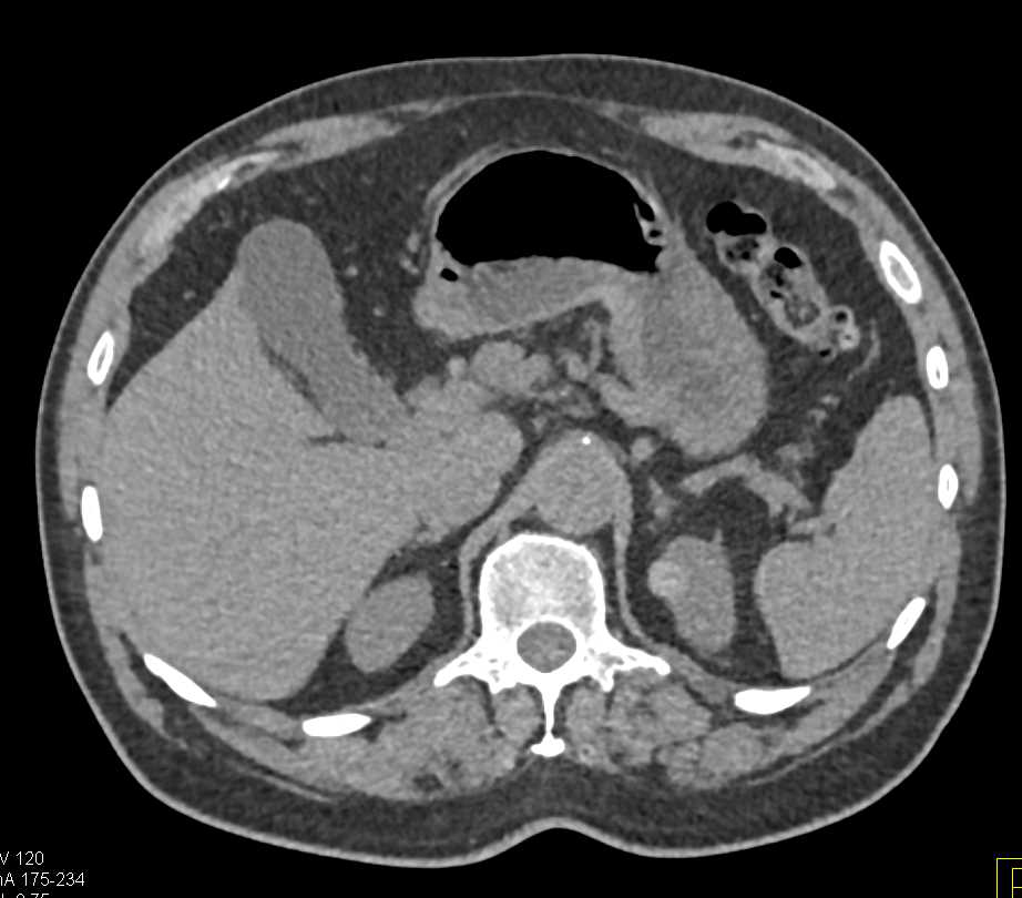 High Density Cyst Upper Pole Left Kidney and Incidental Right Renal Cell Carcinoma - CTisus CT Scan