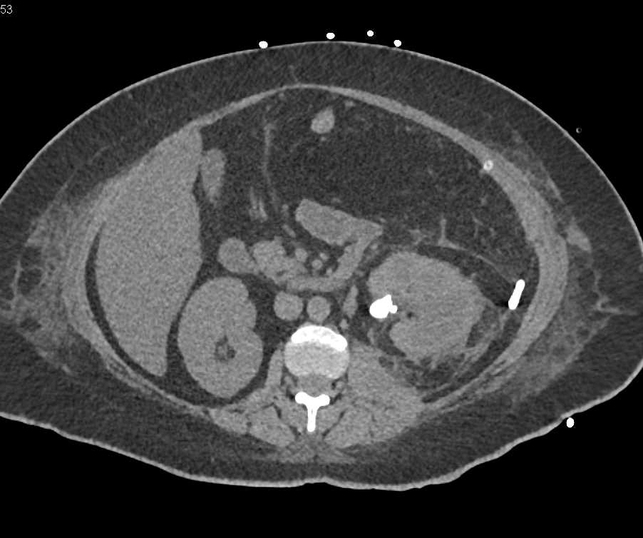Xanthogranulomatous Pyelonephritis (XGP) with Abscess Posterior to the Left Kidney - CTisus CT Scan