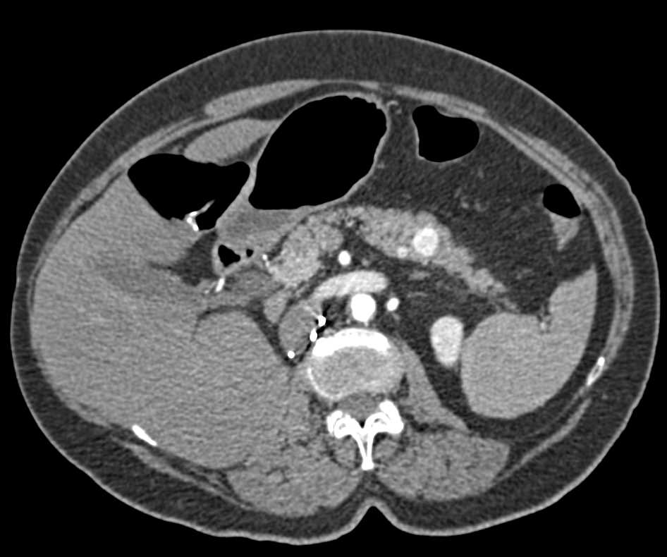 Metastatic Renal Cell Carcinoma to the Contralateral Kidney and the Pancreas - CTisus CT Scan