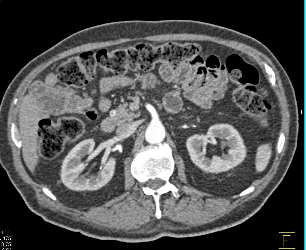 Recurrent Renal Cell Carcinoma to Contralateral Kidney, Pancreas and Bone - CTisus CT Scan
