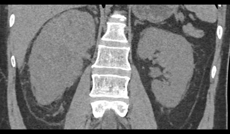 Infiltrating Renal Cell Carcinoma Right Kidney - CTisus CT Scan