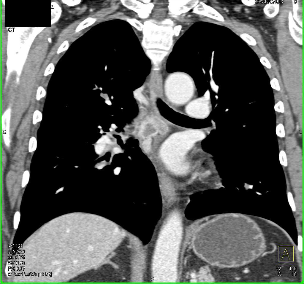 Recurrent Renal Cell Carcinoma Metastatic to the Pancreas and the Mediastinum - CTisus CT Scan
