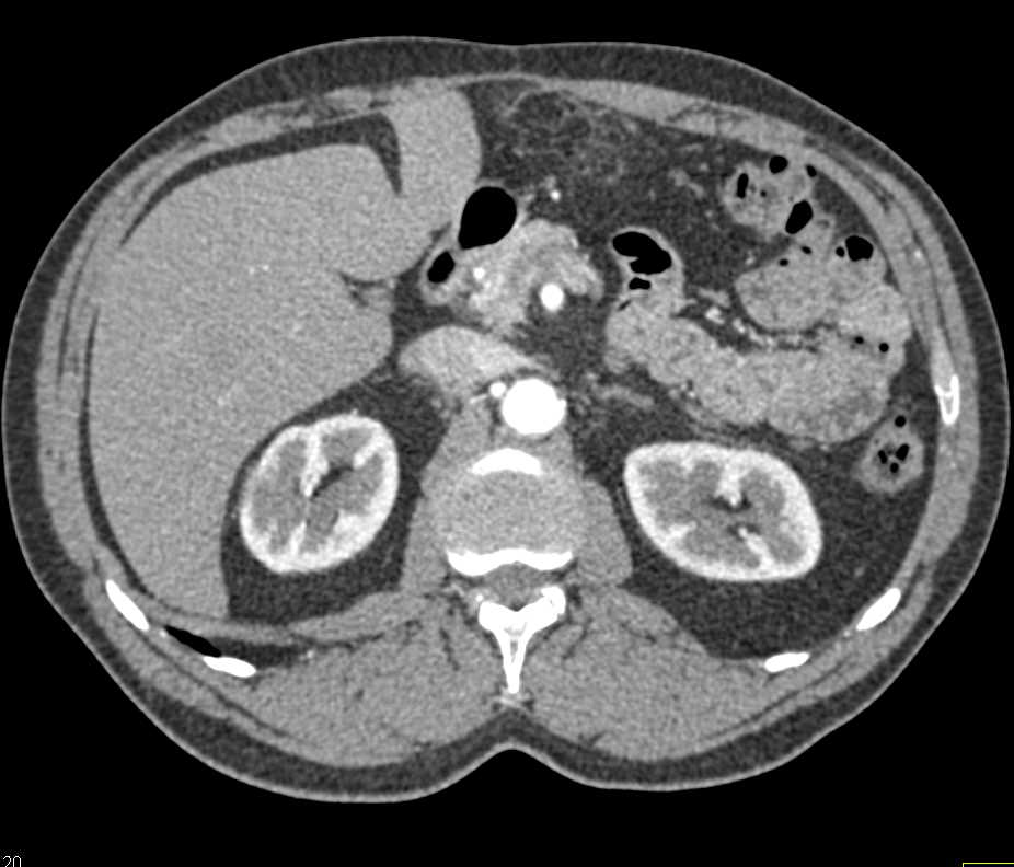 Transitional Cell Cancer (TCC) with Omental Implants - CTisus CT Scan