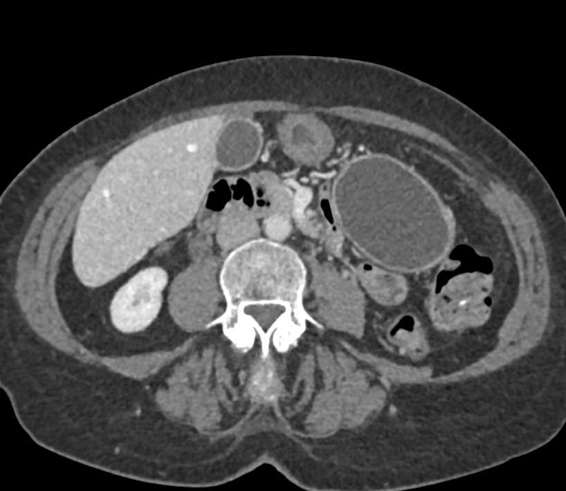 Recurrent Renal Cell Carcinoma with Liver and Bone Metastases - CTisus CT Scan