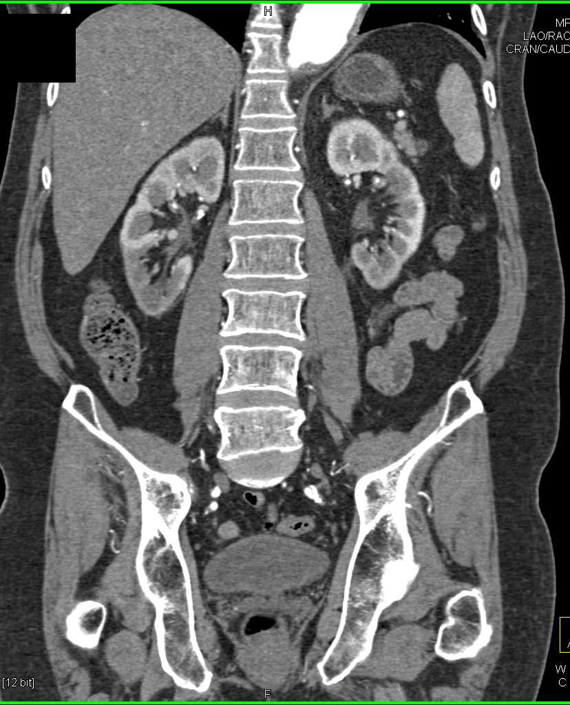 Bilateral Renal Infarcts in a Patient with an Endovascular Stent and Endoleak - CTisus CT Scan