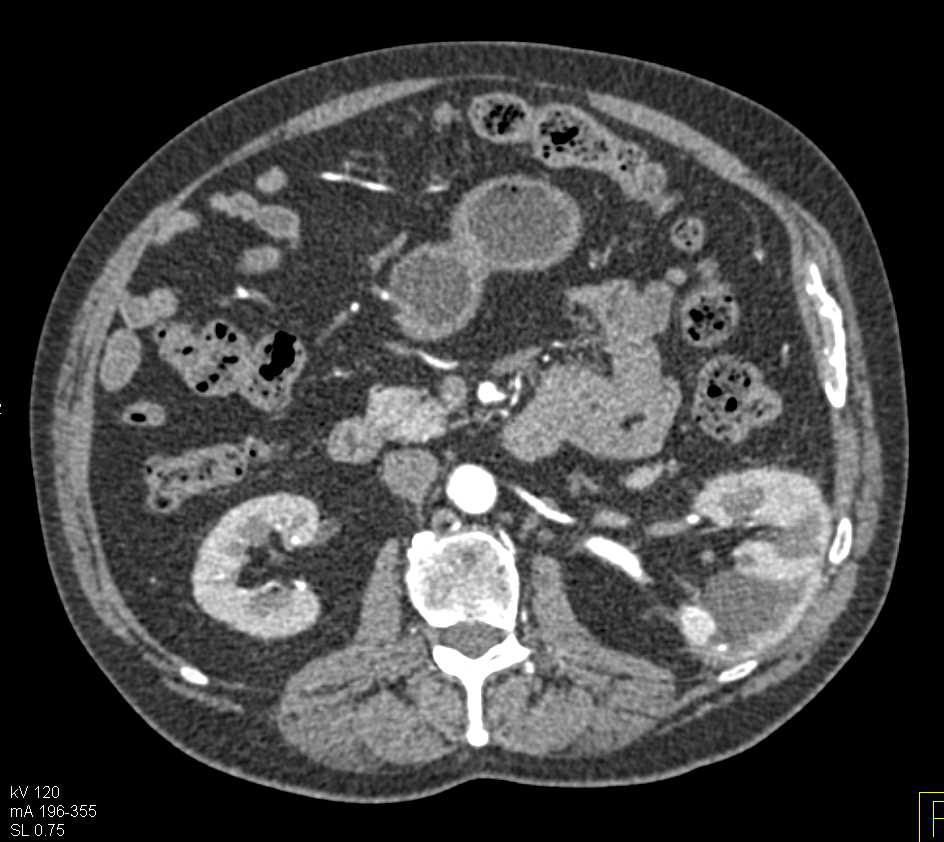Pseudoaneurysm Left Kidney Due to Partial Nephrectomy - CTisus CT Scan