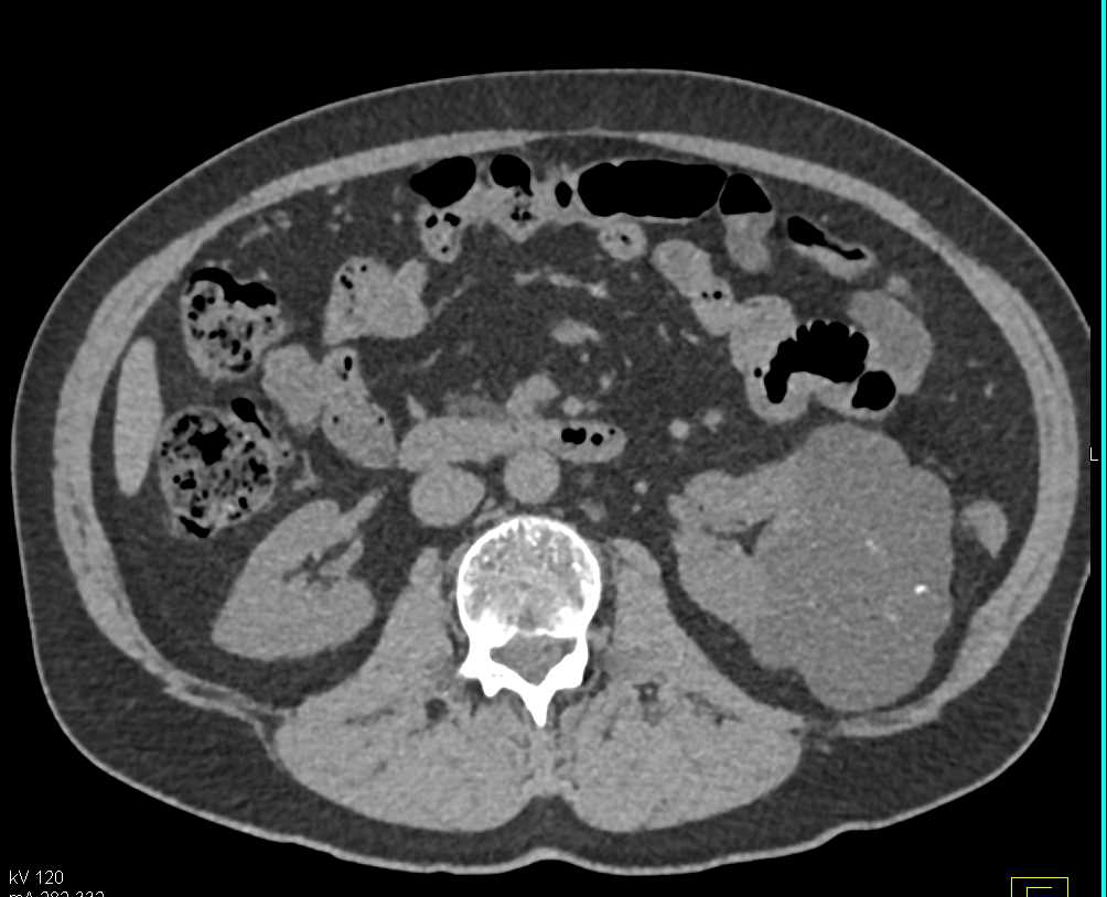 Bosniak 2F Cyst Left Kidney - CTisus CT Scan